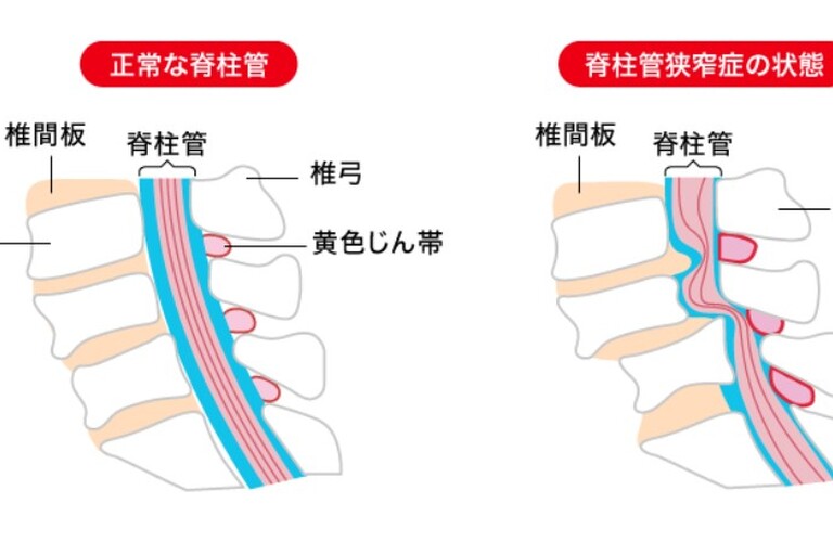 脊柱管狭窄症でお困りの方いませんか？｜神奈川県川崎市の整体ならM.A.K.鍼灸整骨院